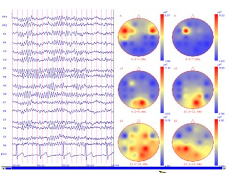 Hand Held Digital EEG Device
