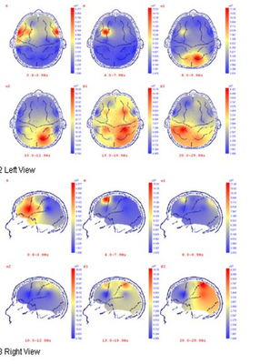 Hand Held Digital EEG Device